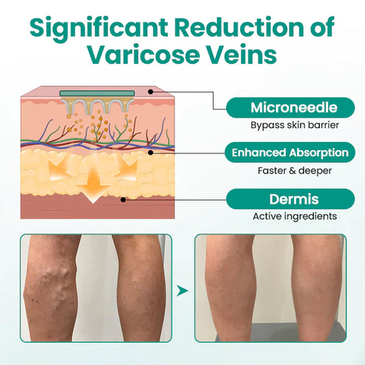 Magnetic Therapy Varicose Veins Patch (PACK OF 20)